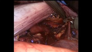 Лапароскопическая нефрэктомия слева. Тромбэктомия из нижней полой вены.