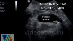 Камень мочеточника