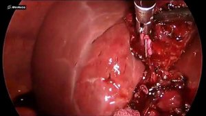 Laparoscopic Cholecystectomy: Acute Calculous Cholecystitis