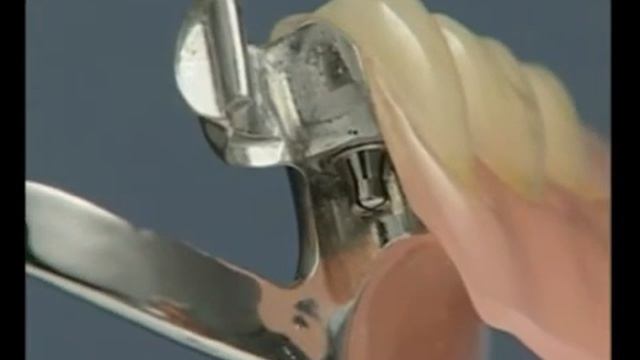 Протез с кнопочным анкером смотреть онлайн