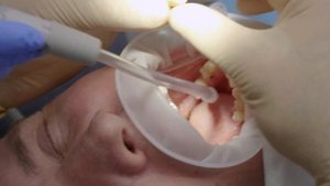 Коронки с опорой на имплантат.