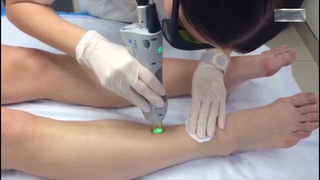 Лазерная эпиляция