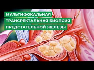 Мультифокальная трансректальная биопсия предстательной железы