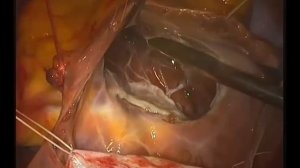 Коррекция аномалии Эбштейна