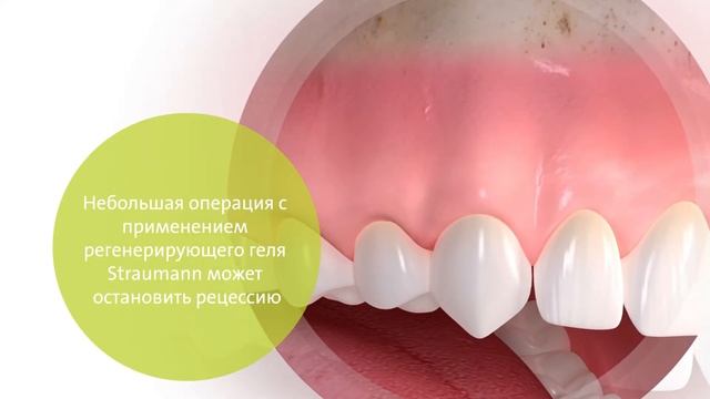 Фильм3 Регенеративная терапия рецессия десны смотреть онлайн