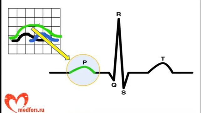 ЭКГ смотреть онлайн