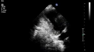 Аневризма левого желудочка