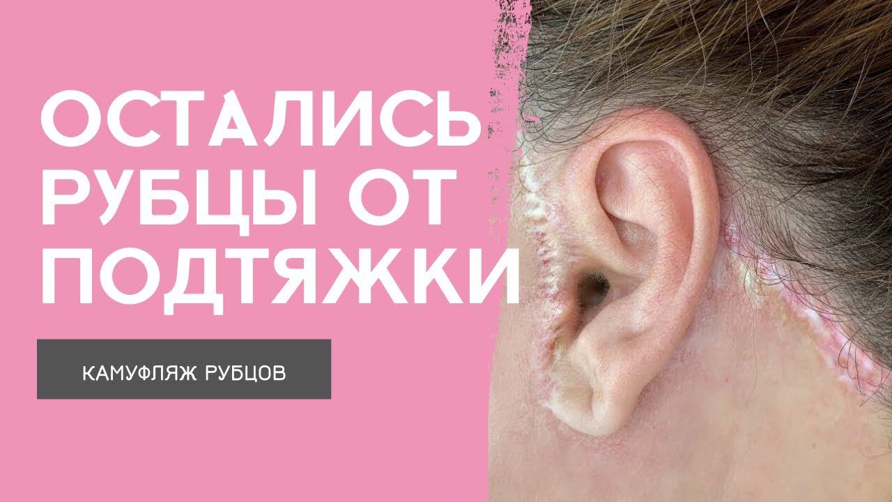 РУБЦЫ ПОСЛЕ ПОДТЯЖКИ ЛИЦА | Шрамы после пластической операции | Камуфляж рубцов после подтяжки