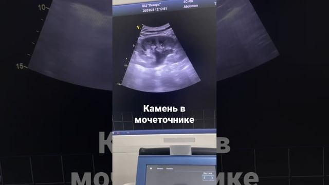 Расширение чашечно лоханочной системы почки обструкцией мочеточника камнем.