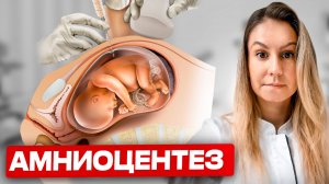 Амниоцентез. ОСЛОЖНЕНИЯ после процедуры. ЗАЧЕМ нужно его делать?