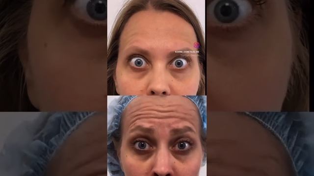 Ботокс лоб глаза межбровье