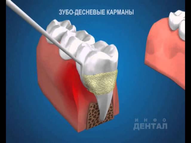 Пародонтальные карманы