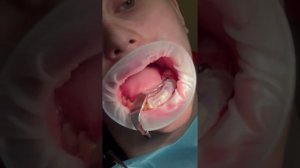 Guided Dental inplant surgery имплантация зуба. установка через навигационный шаблон. AB dental