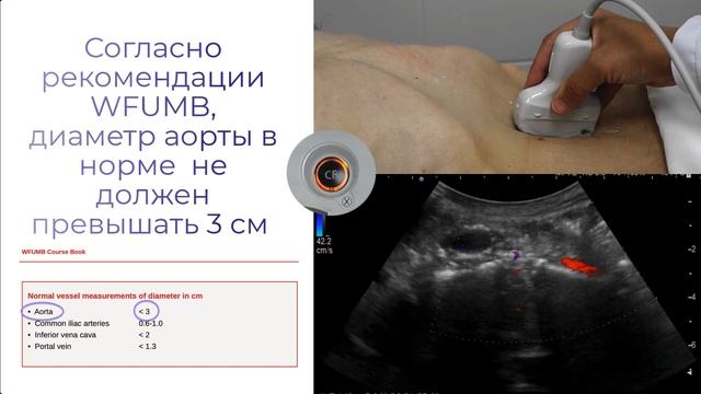 Ультразвуковое исследование  аорты, артерий подвздошных нижних  конечностей