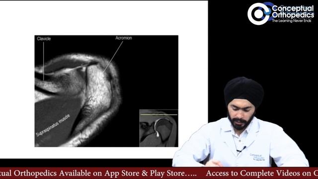 Reading shoulder MRI By Dr. Harpreet Singh смотреть онлайн