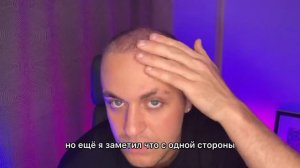 ПОЧЕМУ ТАК?! 2 месяца после пересадки волос. У меня появились вопросы...