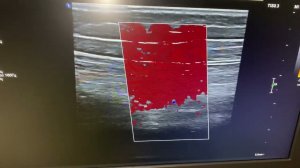 Практическое занятие. УЗИ при облитерирующем атеросклерозе артерий н/к. Ерошенко О.Л.