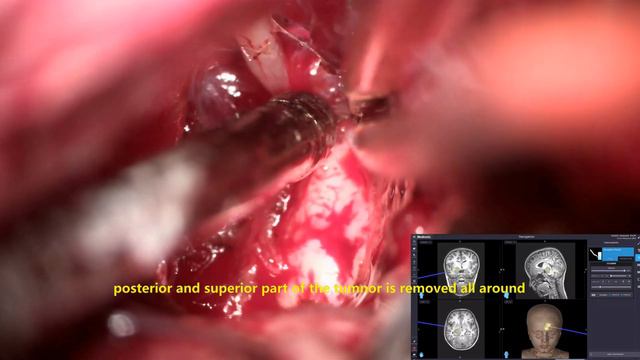 THALAMIC MID BRAIN GLIOMA -NAVIGATION ASSISTED TRANS SYLVIAN MICROSURGICAL REMOVAL-dr suresh dugan смотреть онлайн