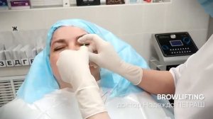 BROWLIFTING | Нитевой лифтинг брови.