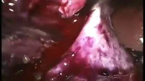 Лапароскопическая нефрэктомия справа