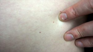 Красные родинки на теле | Почему появляются маленькие красные родинки