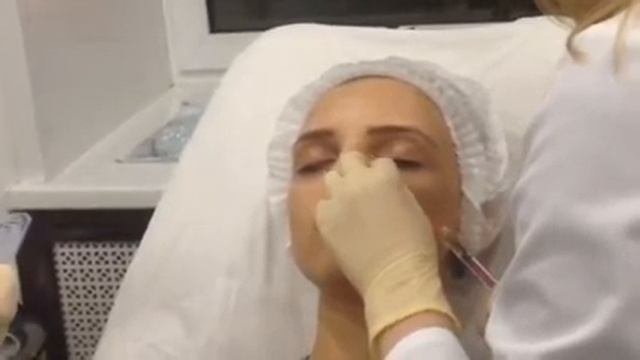 Инъекции филлеров в веки