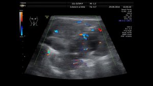 Рак гортани