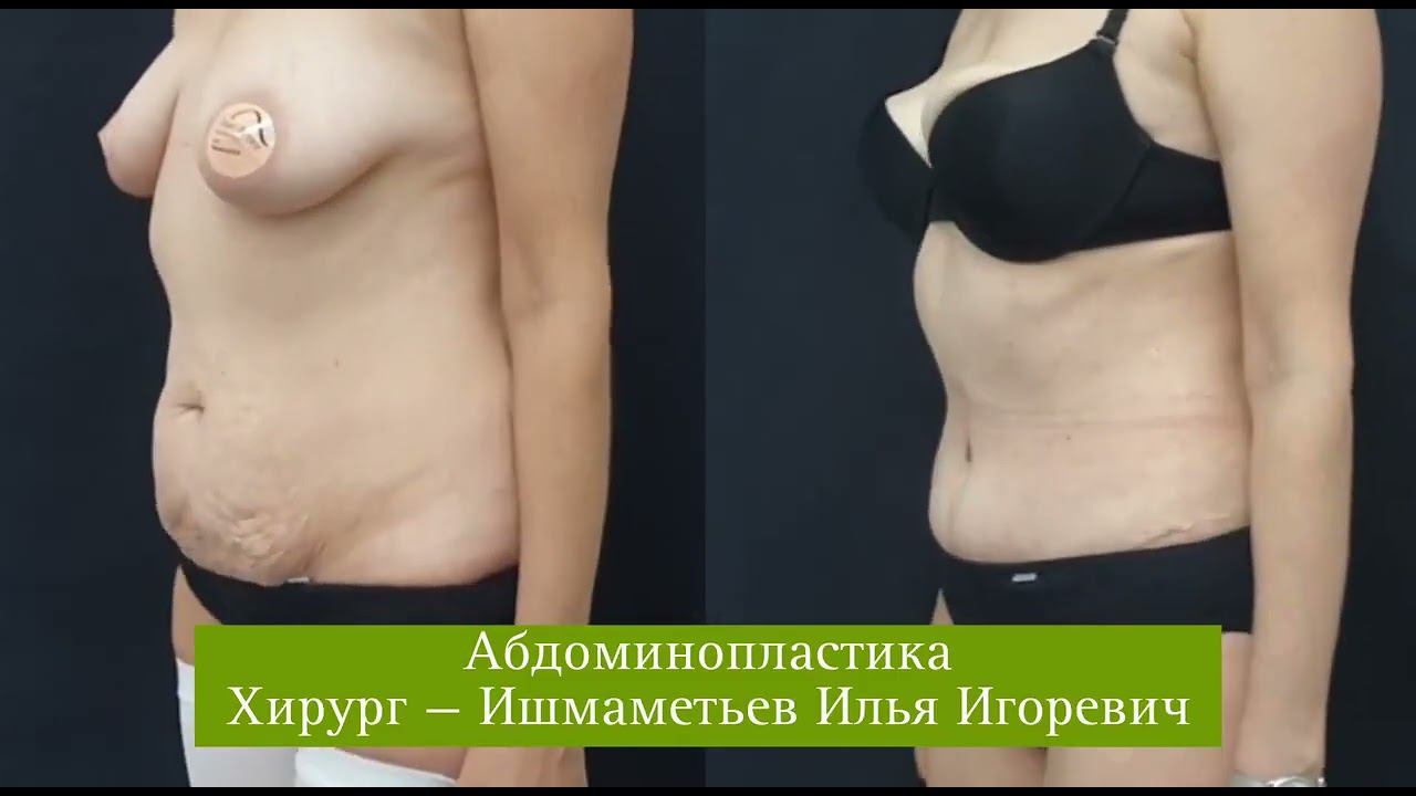Пластические операции Ижевск. Абдоминопластика