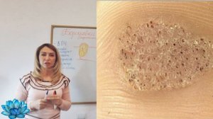 Подошвенная бородавка лечение и причины их появления.