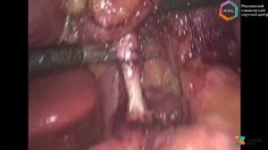 Лапароскопическая проксимальная резекция желудка с D1+ лимфаденэктомией и реконструкцией