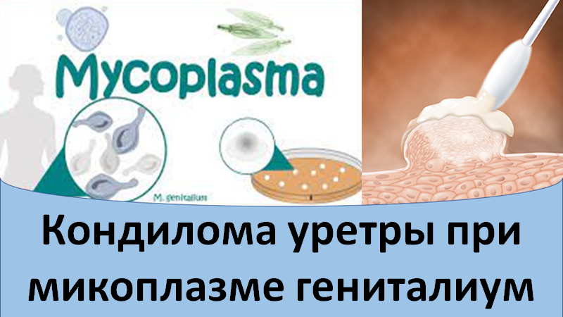 Кондилома уретры при микоплазме гениталиум