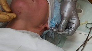 Аптос. Установка нитей. Подтяжка дряблой кожи. Участок под подбородком и края челюсти.