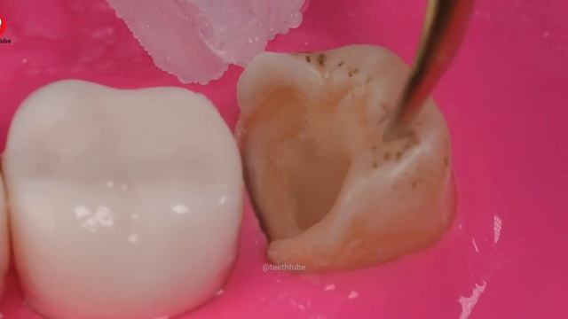 INCREDIBLE Root Canal Procedure смотреть онлайн