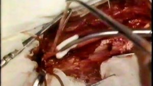 Открытая эндартерэктомия из бедренной артерии. Академик М.И.Кузин © Open endarterectomy