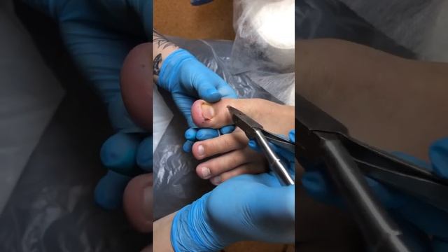 Врастание ногтя с обеих сторон, гипертрофия дистального и бокового валиков. Ребенок - 11 лет смотреть онлайн