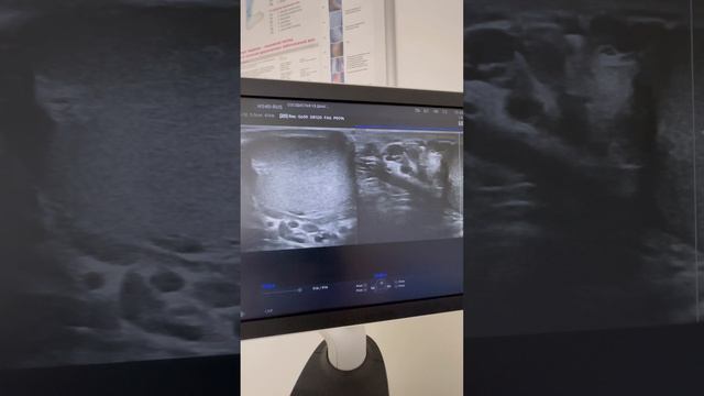 Узи диагностика. Узи сосудов. Варикоцеле. Осмотр сосудистого хирурга. Урология. Флеболог Москва смотреть онлайн