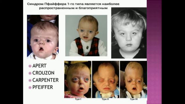Синдром Пфайффера. Причины, профилактика и лечение