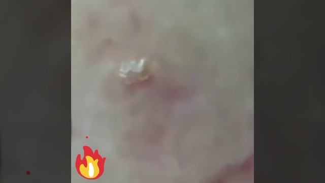 Давим угри, черные точки.