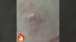 Давим угри, черные точки.