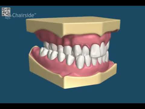 Съемные аппараты смотреть онлайн
