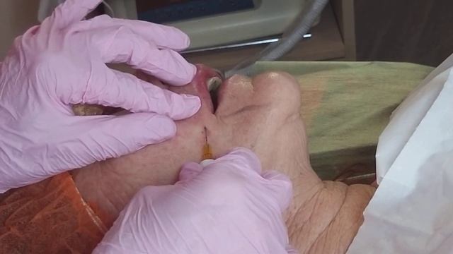 НОСОГУБКА+ГУБЫ+МАРИОНЕТКИ. ГК  КАНЮЛЯ(фрагмент) смотреть онлайн