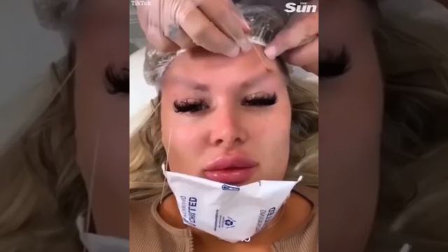 «Жертва пластики»: мечтавшая о внешности Барби блогер показала распухшее от процедур лицо
