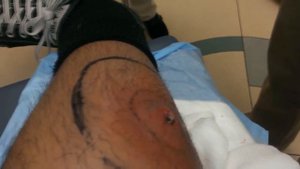 всякие бякушки #11 - огромный мешок гноя на ноге