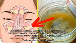Гайморит без температуры и соплей