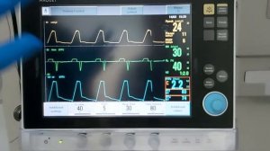 Workshop 18 How to apply  INspiratory hold or pause? Plateau pressure ,static compliance,