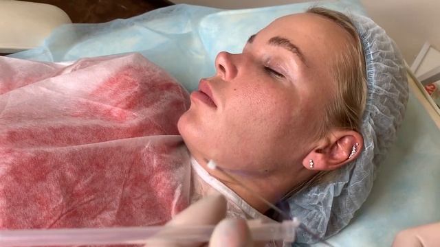 Мастер-класс имплантации нитей сеток и нитей филлеров через один прокол. смотреть онлайн