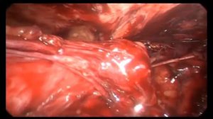 Ущемленная  паховая грыжа, TAPP