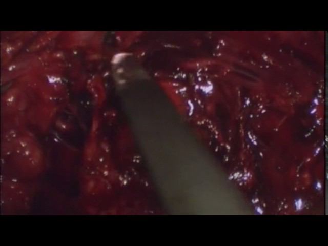 Postoperative inguinal pain, mesh removal смотреть онлайн