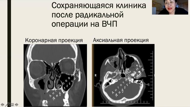 Надо ли делать контроль КТ ОНП? смотреть онлайн