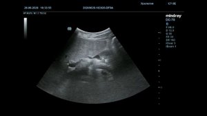 Субкапсулярная гематома печени